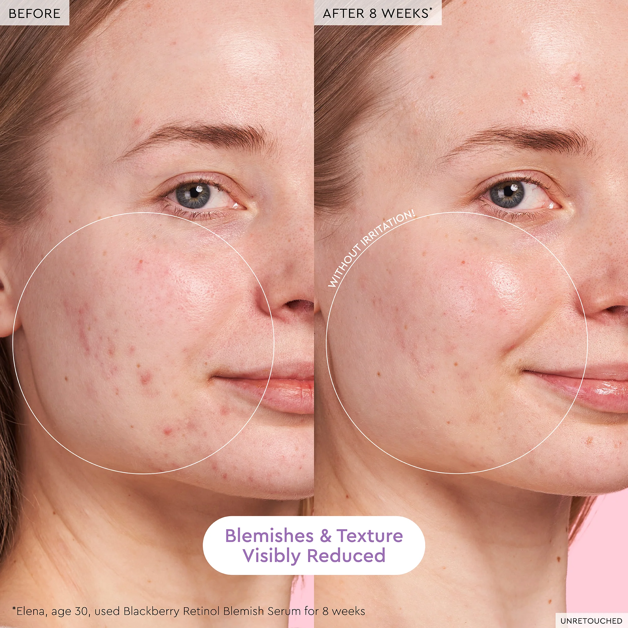 Blackberry Retinol Blemish Serum - Image 3