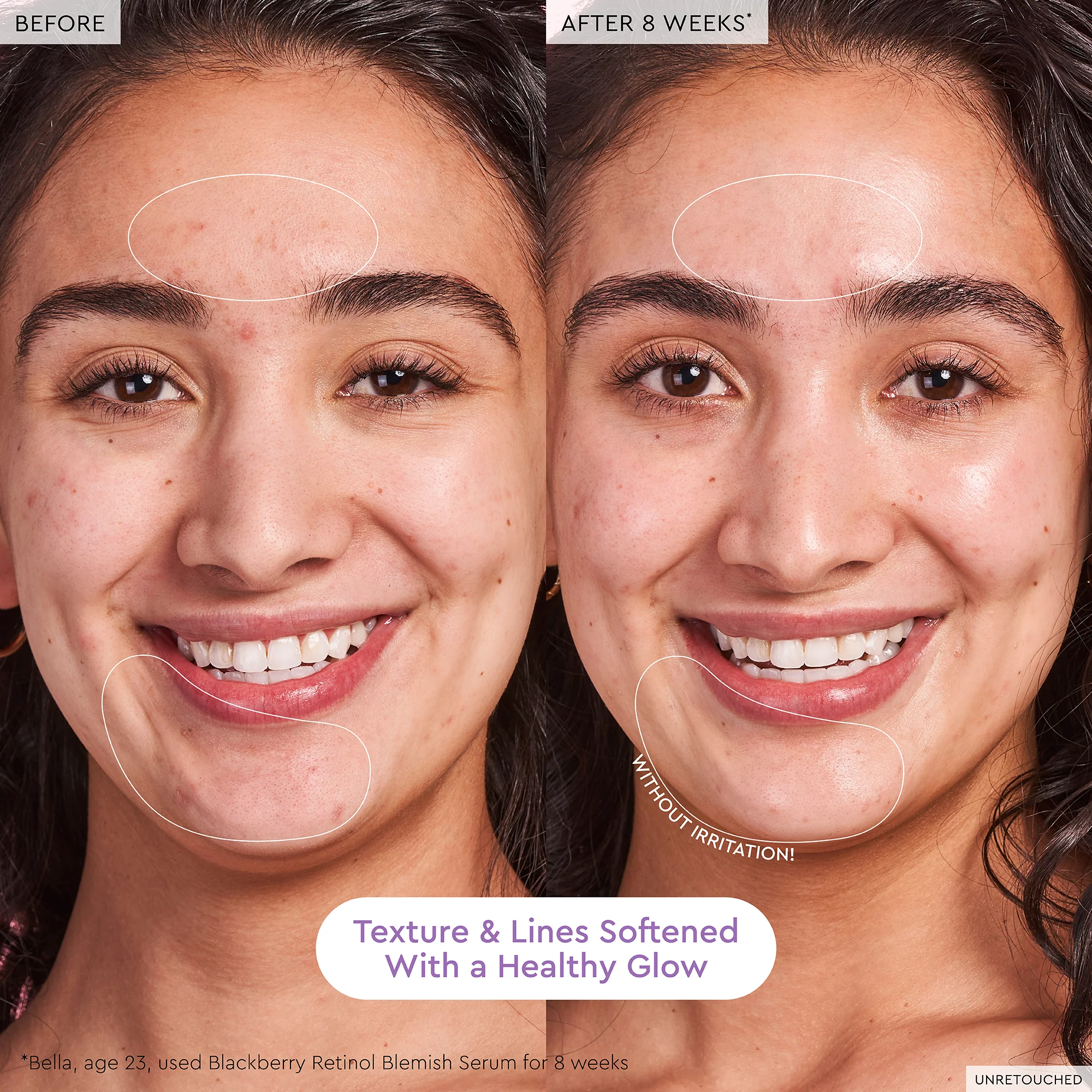 Blackberry Retinol Blemish Serum - Image 6